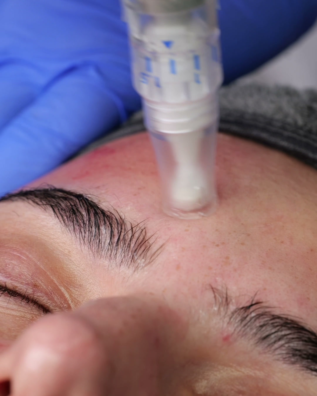Microneedling med mikronålspenna mot pannan
